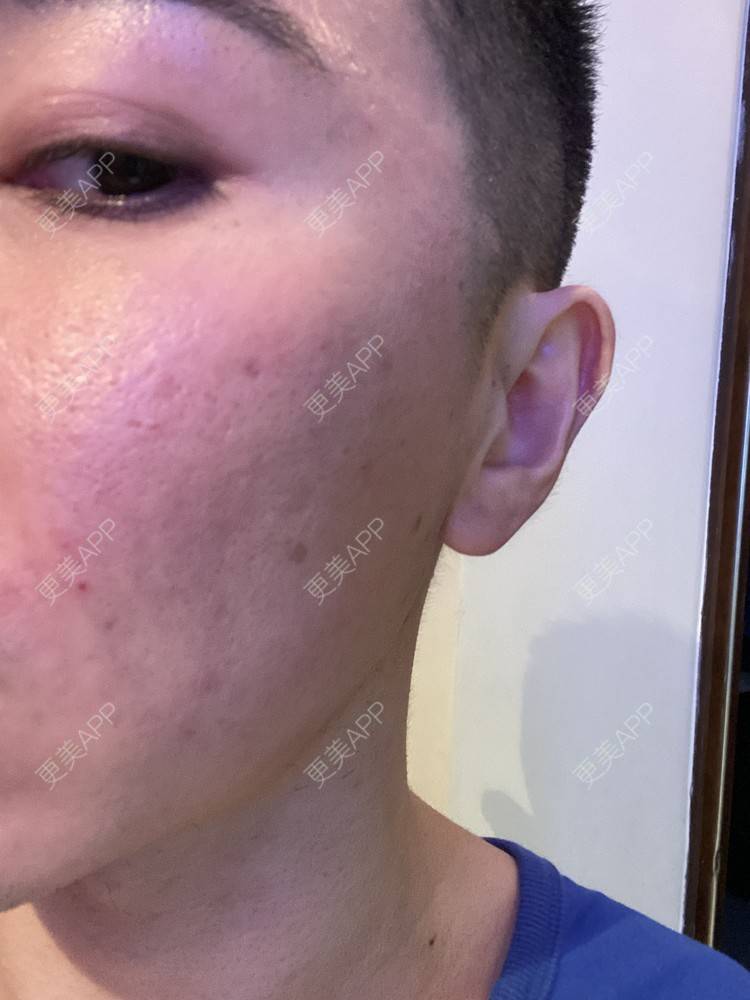 更美 - Es小喵的埋线提升经验 | 广州 | 埋线提升 | 埋线除皱 | V脸套餐