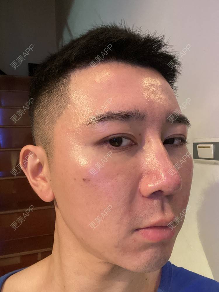 更美 - Es小喵的埋线提升经验 | 广州 | 埋线提升 | 埋线除皱 | V脸套餐