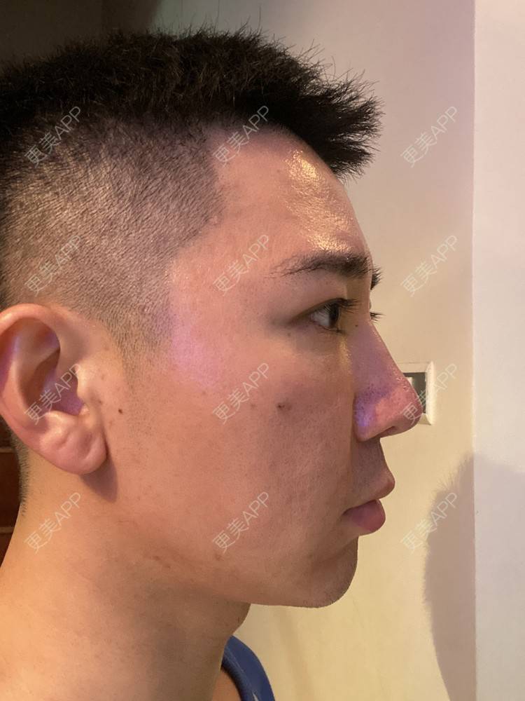 更美 - Es小喵的埋线提升经验 | 广州 | 埋线提升 | 埋线除皱 | V脸套餐