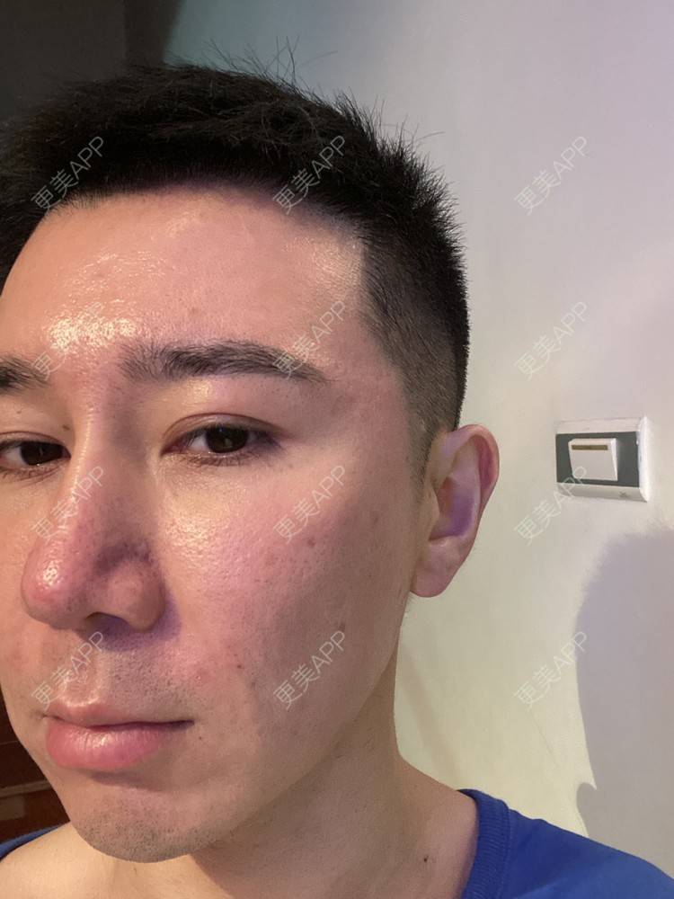 更美 - Es小喵的埋线提升经验 | 广州 | 埋线提升 | 埋线除皱 | V脸套餐