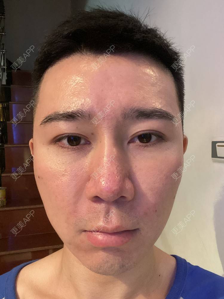 更美 - Es小喵的埋线提升经验 | 广州 | 埋线提升 | 埋线除皱 | V脸套餐