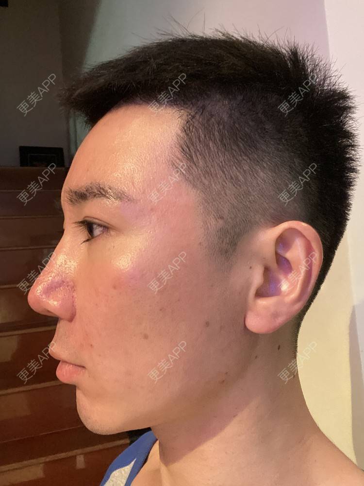 更美 - Es小喵的埋线提升经验 | 广州 | 埋线提升 | 埋线除皱 | V脸套餐