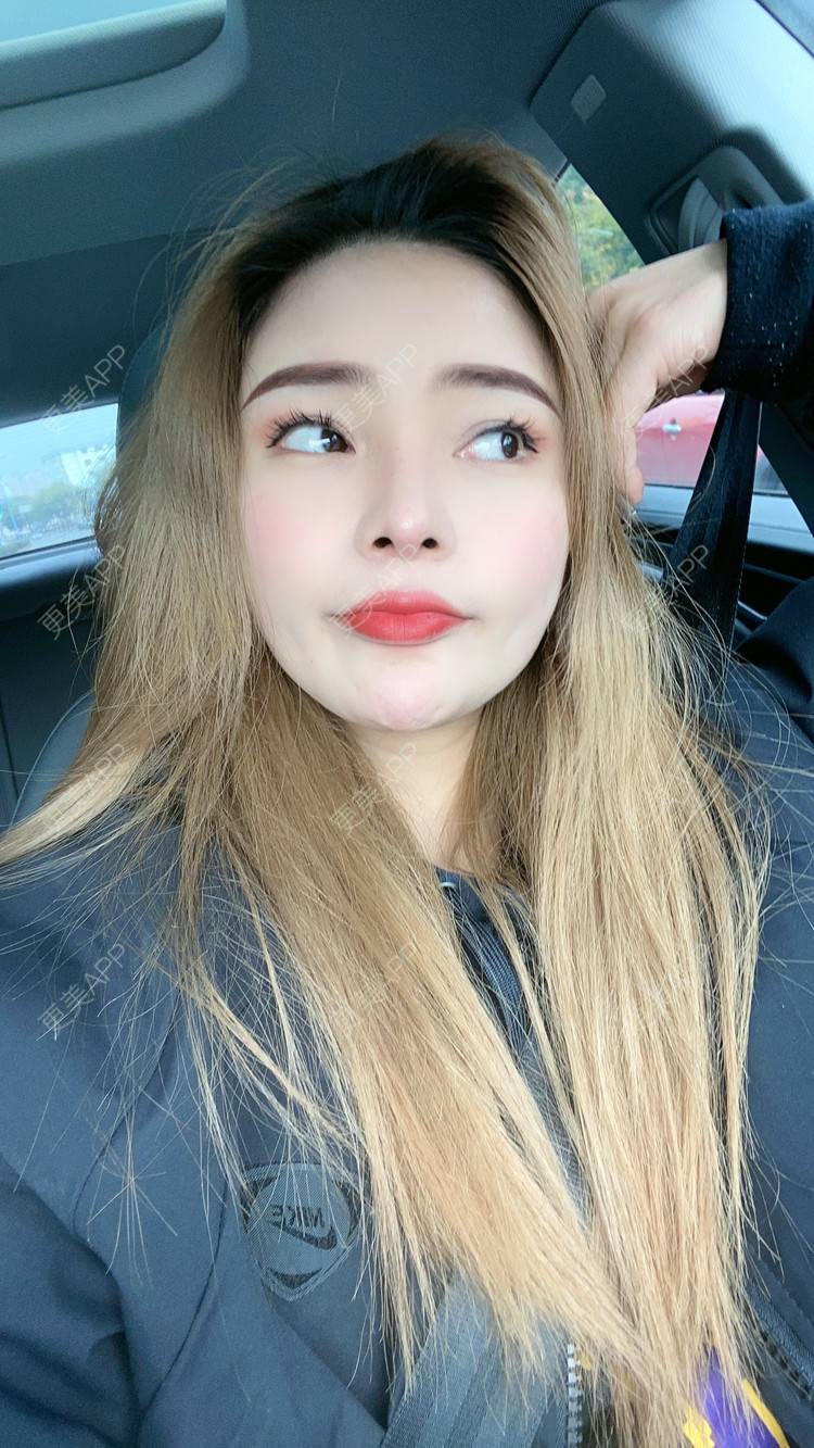 更美 - 大CC阿姨的肋软骨隆鼻经验 | 成都 | 肋软骨隆鼻 | 视频日记