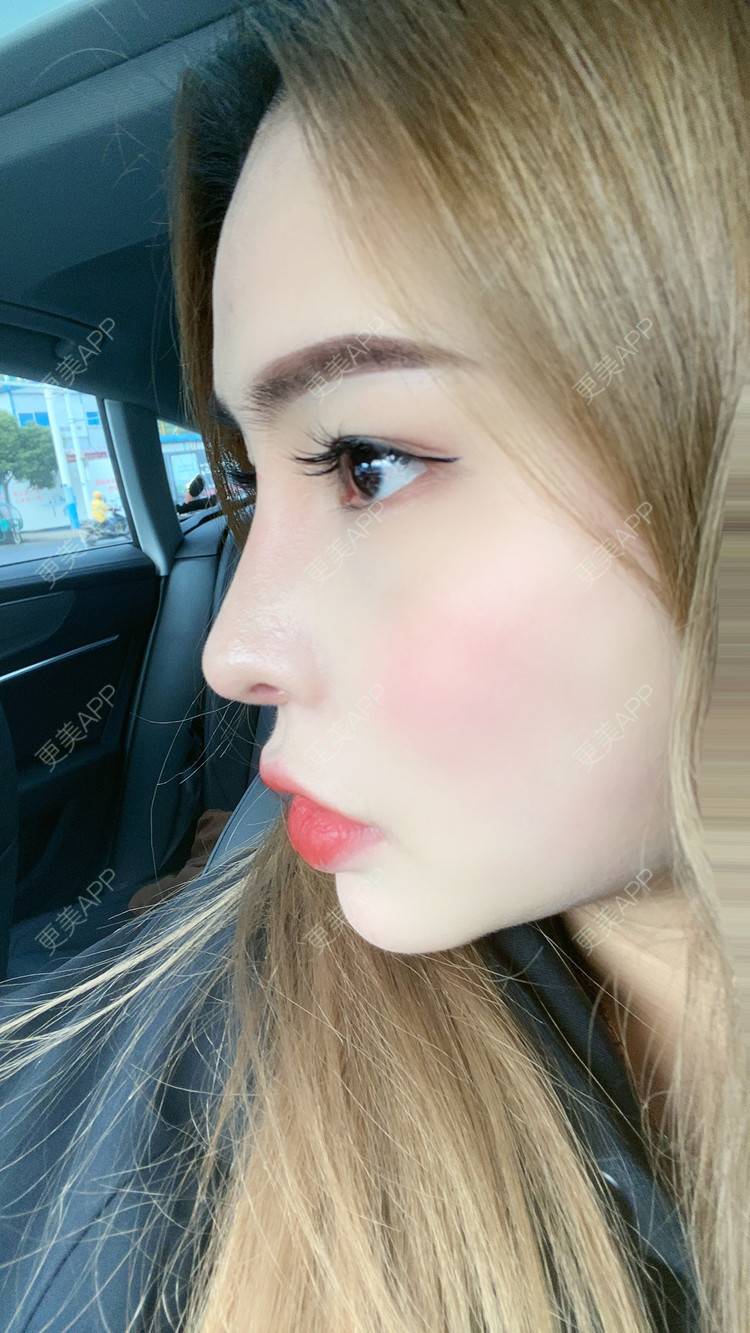 更美 - 大CC阿姨的肋软骨隆鼻经验 | 成都 | 肋软骨隆鼻 | 视频日记