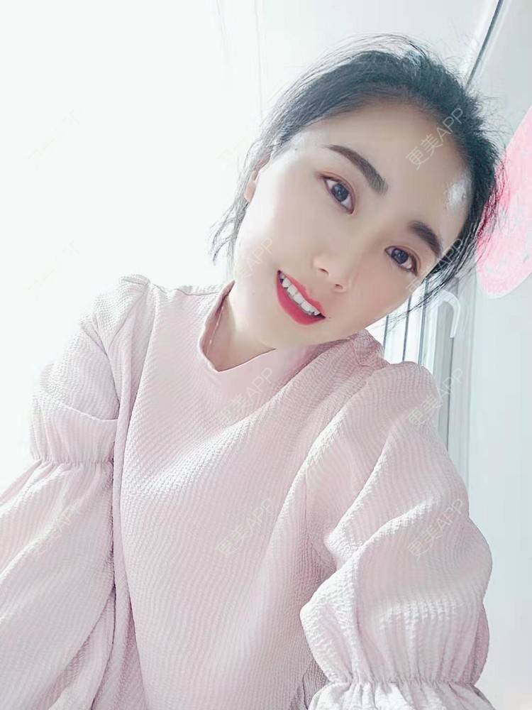 更美 - 更美魔女的埋线提升经验 | 埋线提升 | 郑州 | 埋线除皱