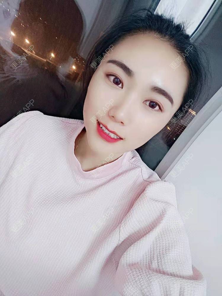 更美 - 更美魔女的埋线提升经验 | 埋线提升 | 郑州 | 埋线除皱