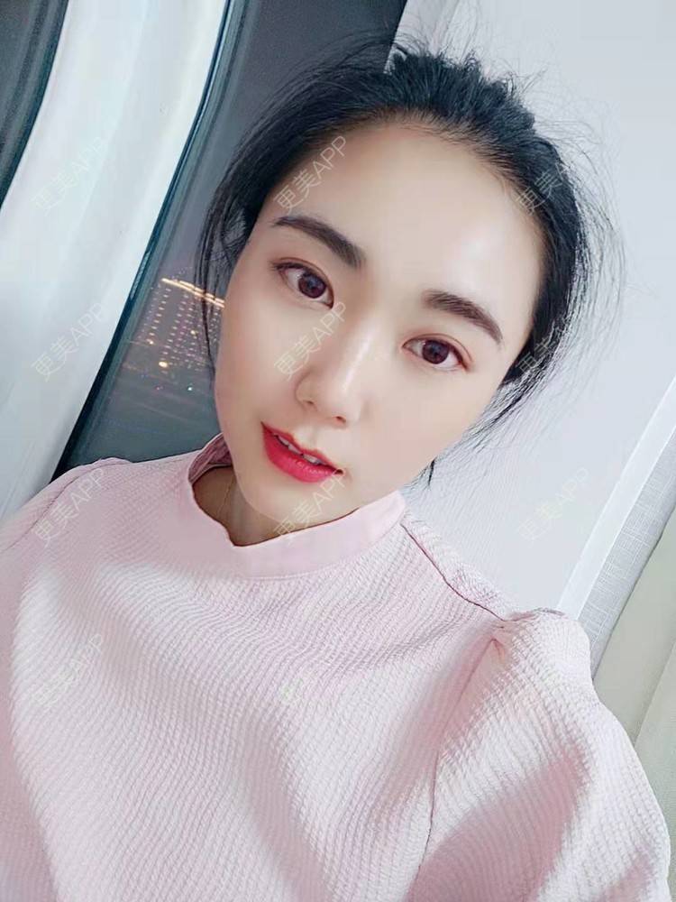 更美 - 更美魔女的埋线提升经验 | 埋线提升 | 郑州 | 埋线除皱