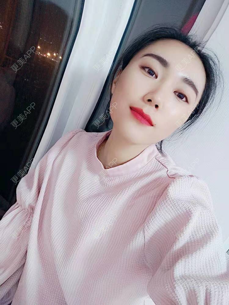 更美 - 更美魔女的埋线提升经验 | 埋线提升 | 郑州 | 埋线除皱