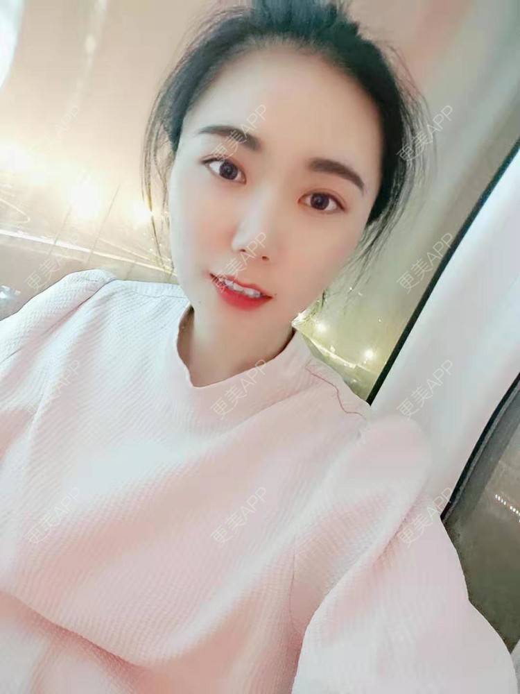 更美 - 更美魔女的埋线提升经验 | 埋线提升 | 郑州 | 埋线除皱