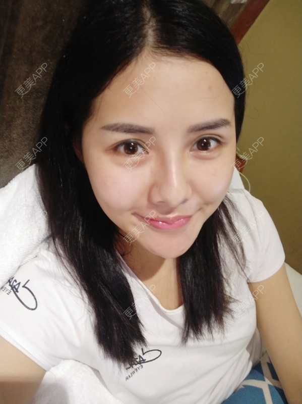 更美 - Daisy11的自体脂肪全面部填充经验 | 自体脂肪全面部填充 | 视频日记 | 重庆
