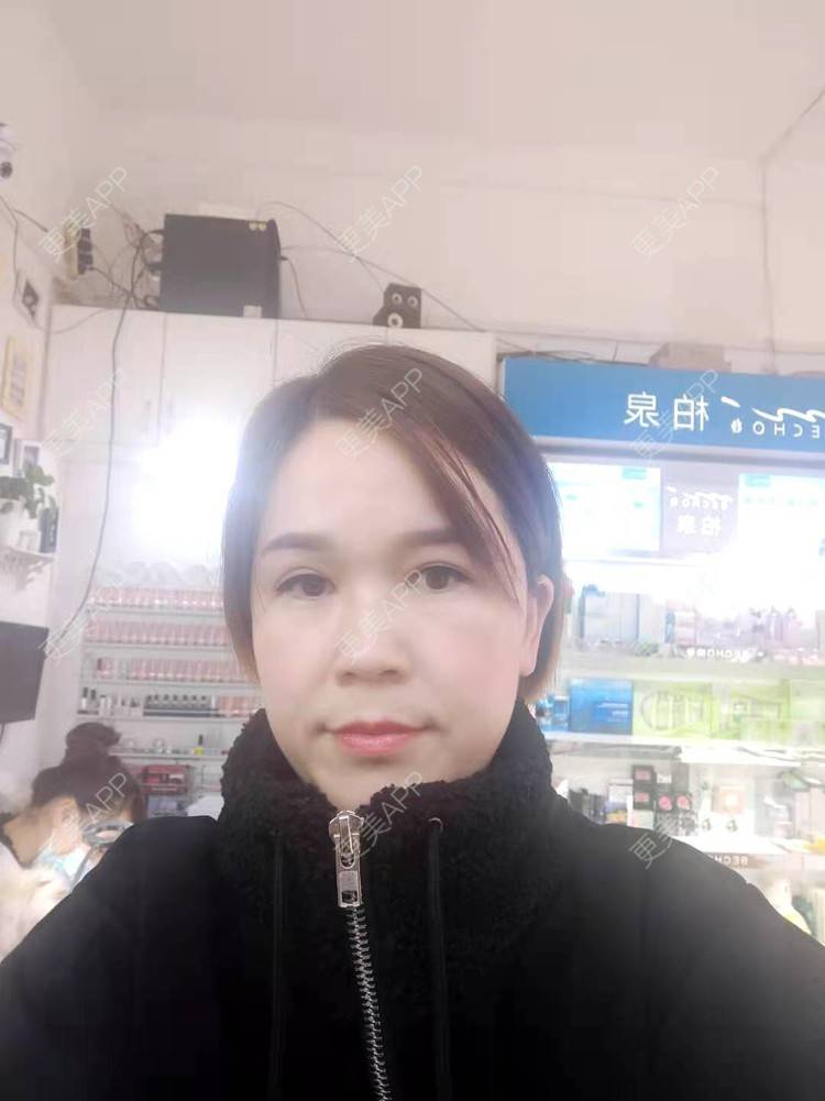 更美 - 更美用户N2lVG08Hz7的太阳穴经验 | 硅胶丰太阳穴 | 太阳穴 | 膨体丰太阳穴 | 玻尿酸太阳穴 | 自体脂肪丰太阳穴 | 眼皮下垂矫正 | 武汉 | 眼睑