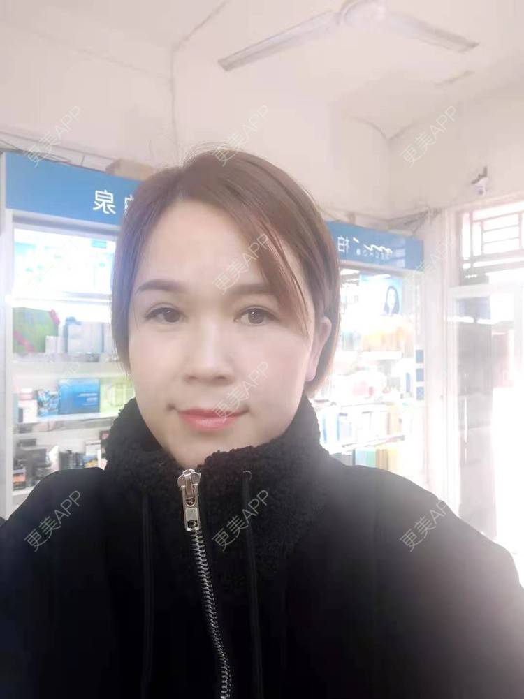 更美 - 更美用户N2lVG08Hz7的太阳穴经验 | 硅胶丰太阳穴 | 太阳穴 | 膨体丰太阳穴 | 玻尿酸太阳穴 | 自体脂肪丰太阳穴 | 眼皮下垂矫正 | 武汉 | 眼睑
