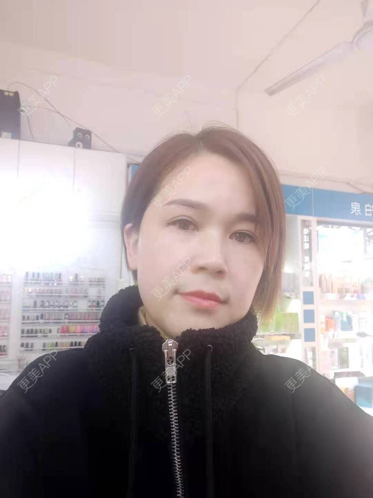 更美 - 更美用户N2lVG08Hz7的太阳穴经验 | 硅胶丰太阳穴 | 太阳穴 | 膨体丰太阳穴 | 玻尿酸太阳穴 | 自体脂肪丰太阳穴 | 眼皮下垂矫正 | 武汉 | 眼睑