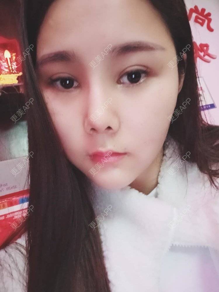 更美 - 婷婷玉立在夏天的鼻部多项经验 | 重庆 | 硅胶隆鼻 | 自体软骨垫鼻尖 | 鼻部多项 | 鼻翼缩小