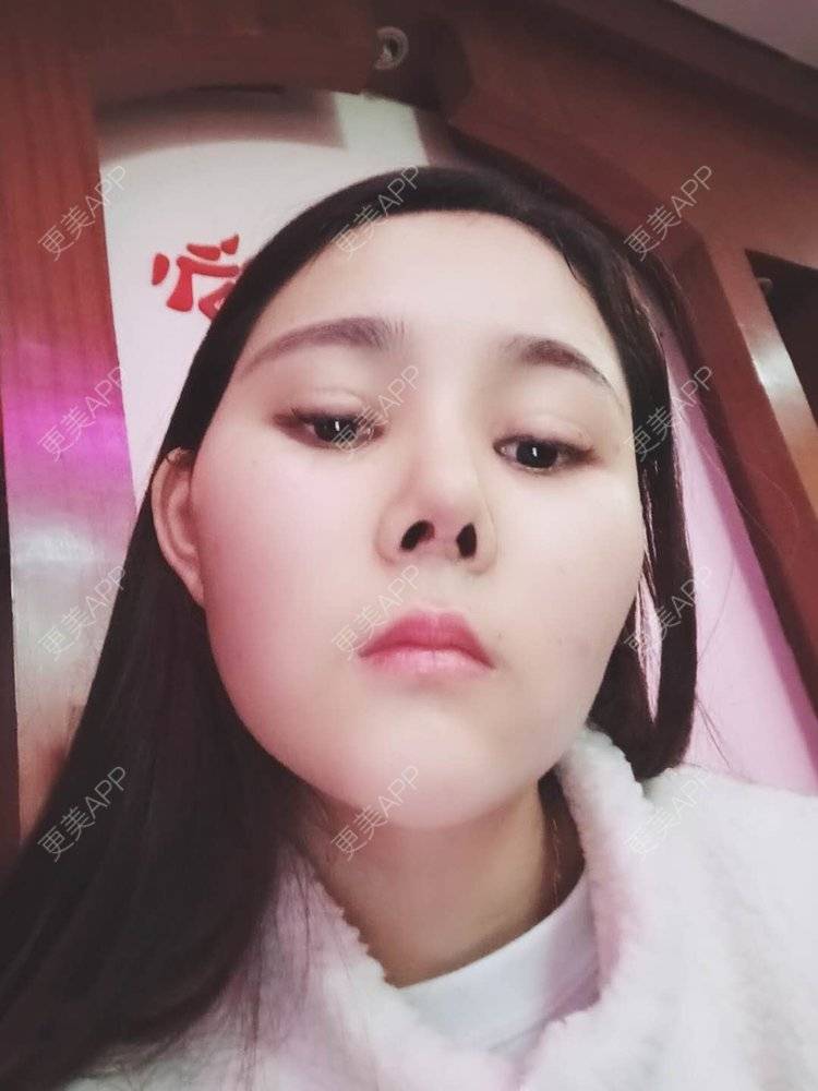 更美 - 婷婷玉立在夏天的鼻部多项经验 | 重庆 | 硅胶隆鼻 | 自体软骨垫鼻尖 | 鼻部多项 | 鼻翼缩小
