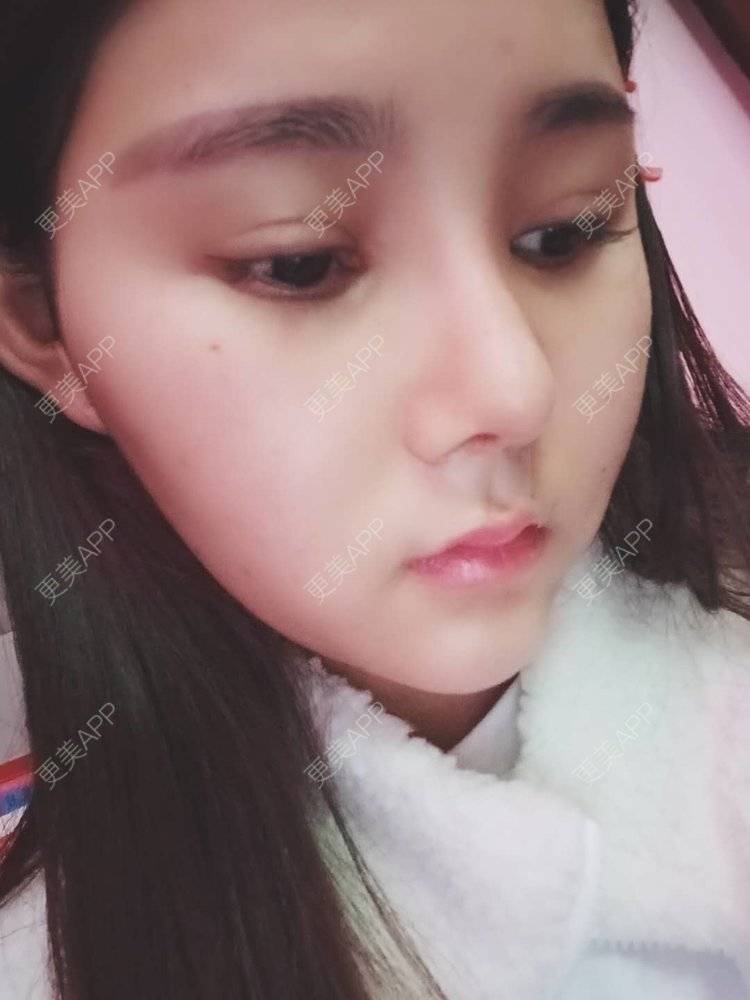 更美 - 婷婷玉立在夏天的鼻部多项经验 | 重庆 | 硅胶隆鼻 | 自体软骨垫鼻尖 | 鼻部多项 | 鼻翼缩小
