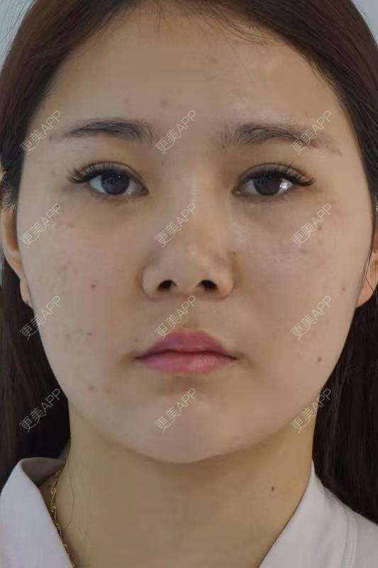 更美 - 婷婷玉立在夏天的鼻部多项经验 | 重庆 | 硅胶隆鼻 | 自体软骨垫鼻尖 | 鼻部多项 | 鼻翼缩小