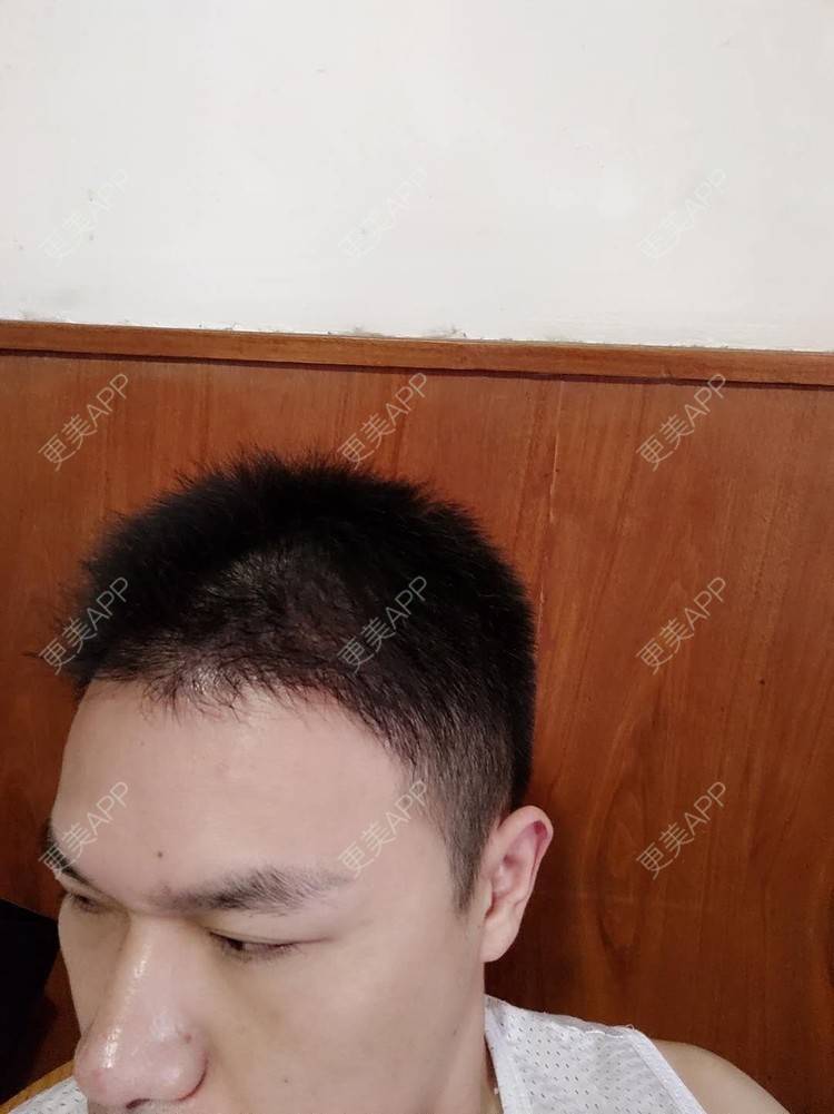 更美 - 更美用户bwkaRG3otA的太阳穴经验 | 硅胶丰太阳穴 | 太阳穴 | 膨体丰太阳穴 | 自体脂肪丰太阳穴 | 玻尿酸太阳穴 | 植发际线 | 武汉 | 毛发移植