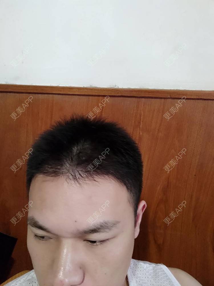 更美 - 更美用户bwkaRG3otA的太阳穴经验 | 硅胶丰太阳穴 | 太阳穴 | 膨体丰太阳穴 | 自体脂肪丰太阳穴 | 玻尿酸太阳穴 | 植发际线 | 武汉 | 毛发移植