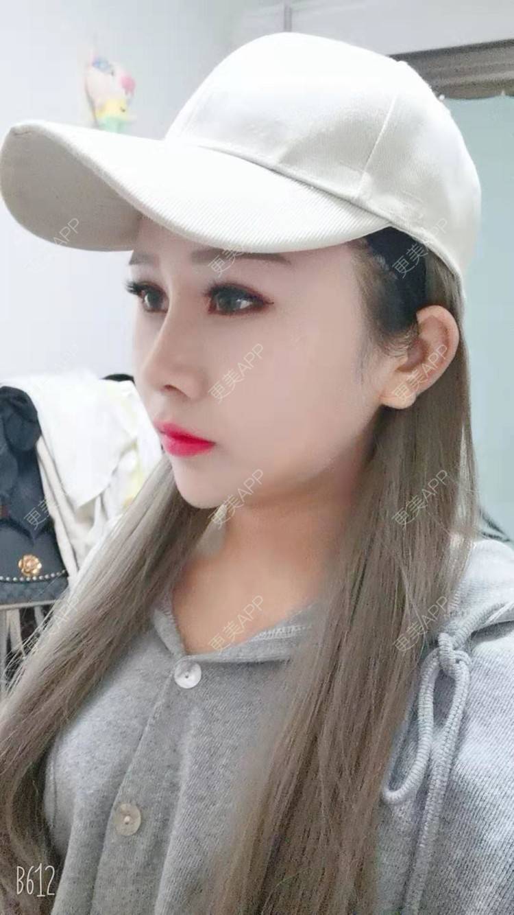 更美 - 猥琐女放的下颌角切除经验 | 上海 | 颧骨内推 | 下颌角切除