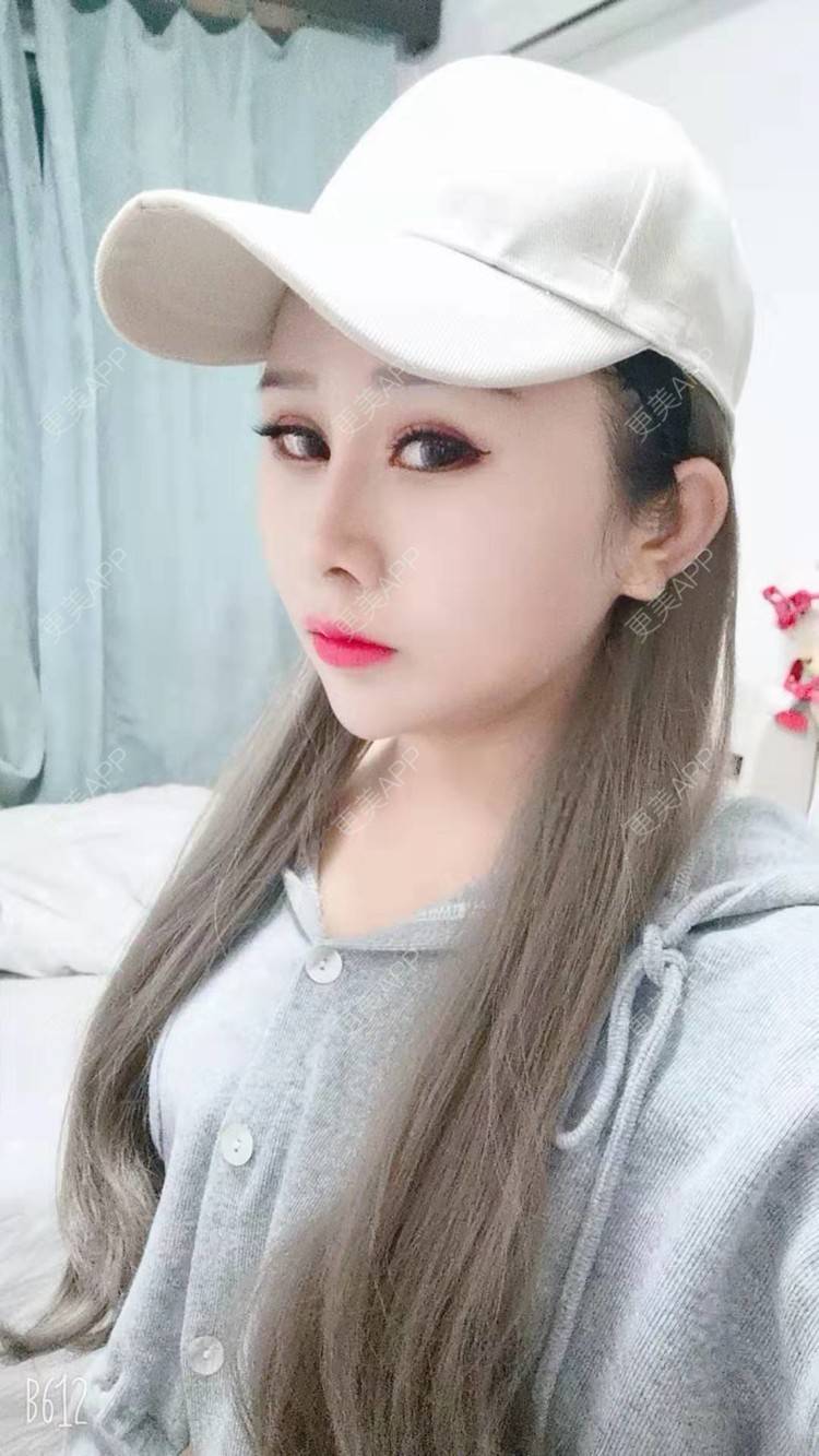 更美 - 猥琐女放的下颌角切除经验 | 上海 | 颧骨内推 | 下颌角切除