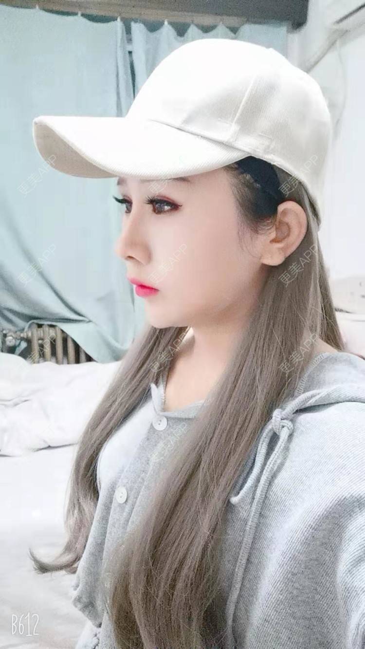 更美 - 猥琐女放的下颌角切除经验 | 上海 | 颧骨内推 | 下颌角切除