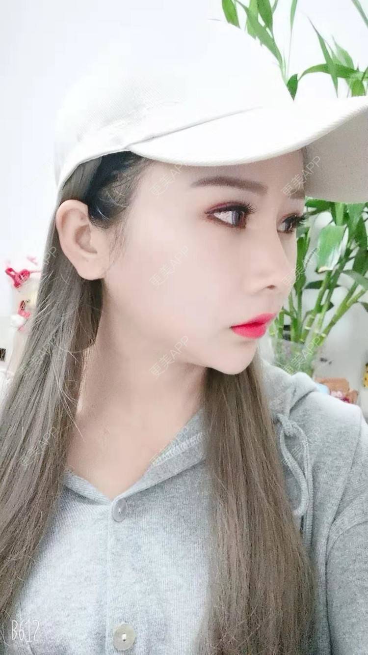 更美 - 猥琐女放的下颌角切除经验 | 上海 | 颧骨内推 | 下颌角切除