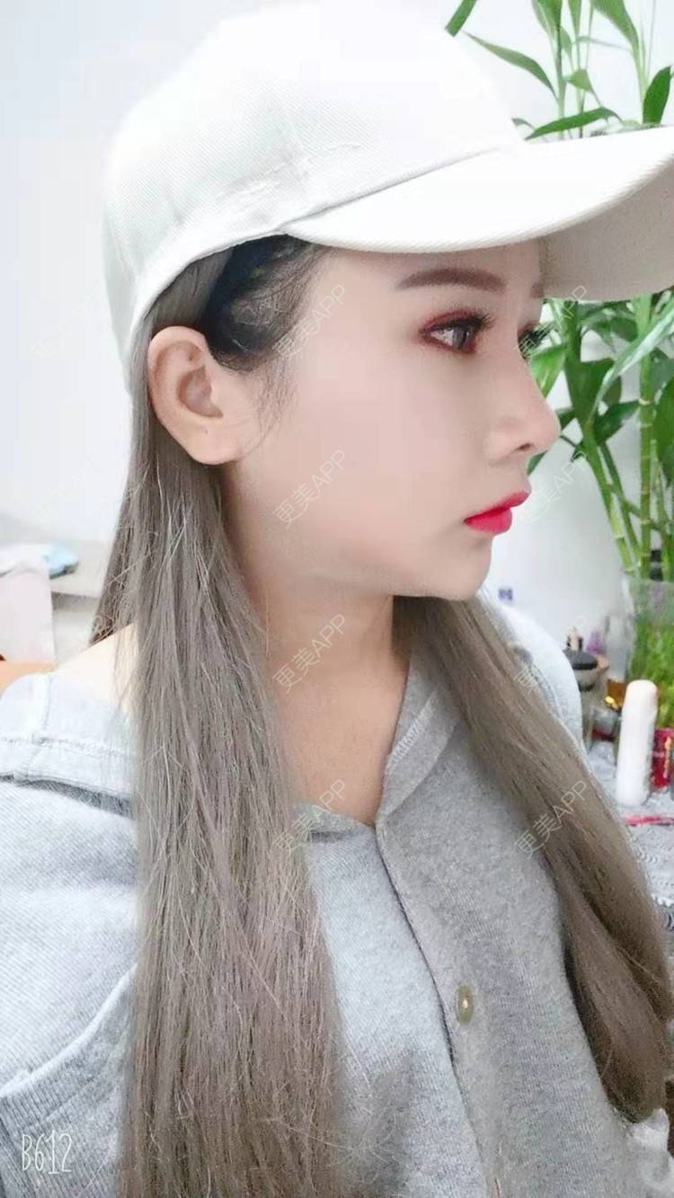 更美 - 猥琐女放的下颌角切除经验 | 上海 | 颧骨内推 | 下颌角切除