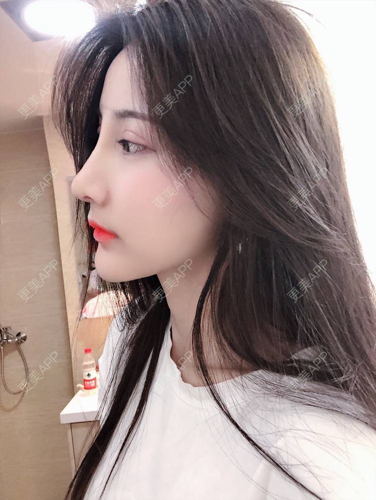 隆鼻,隆鼻效果图_伤源隆鼻效果图_术后627天__更美