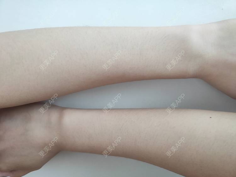 更美 - 更美用户ULBdsFURSw的手臂脱毛经验 | 广州 | 视频日记 | 手臂脱毛