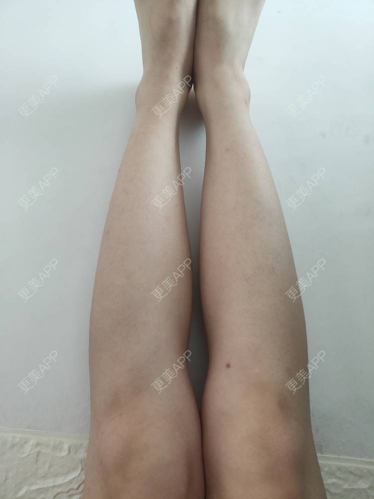 更美 - 更美用户ULBdsFURSw的手臂脱毛经验 | 广州 | 视频日记 | 手臂脱毛