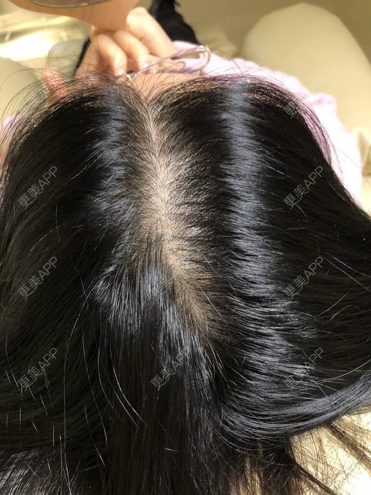 更美 - 丽碧丝上海静安店的头顶加密种植经验 | 毛囊检测 | 头顶加密种植 | 上海