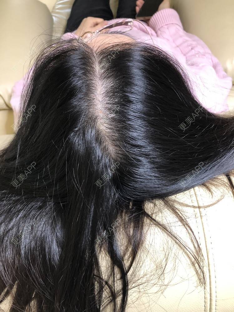 更美 - 丽碧丝上海静安店的头顶加密种植经验 | 毛囊检测 | 头顶加密种植 | 上海