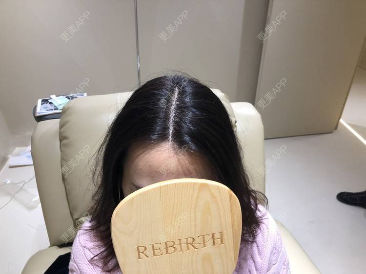 更美 - 丽碧丝上海静安店的头顶加密种植经验 | 毛囊检测 | 头顶加密种植 | 上海