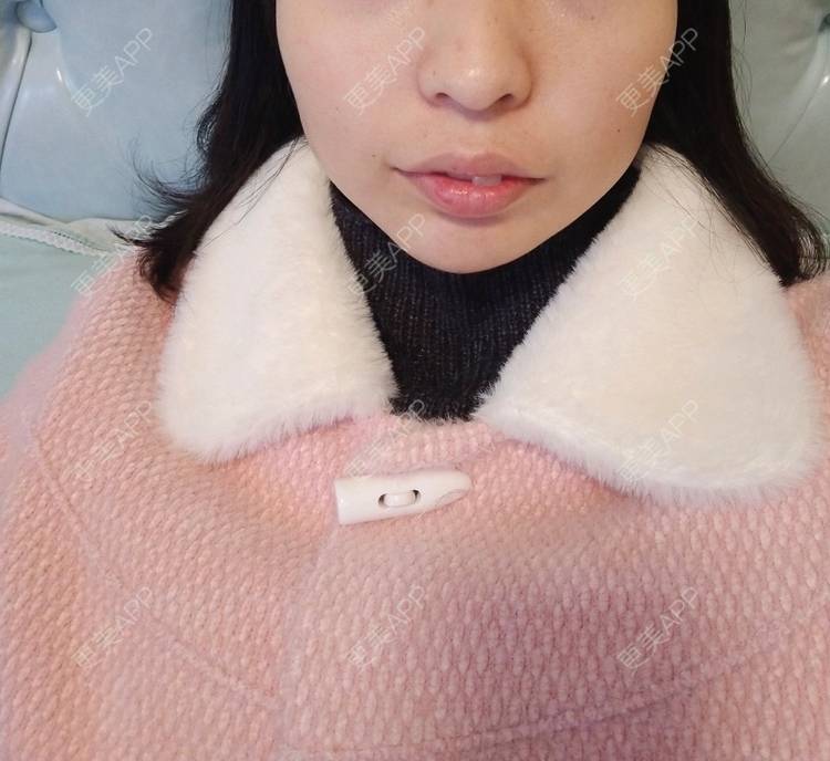 更美 - 更美用户33jmvOkmJt的玻尿酸下巴经验 | 玻尿酸下巴 | 重庆