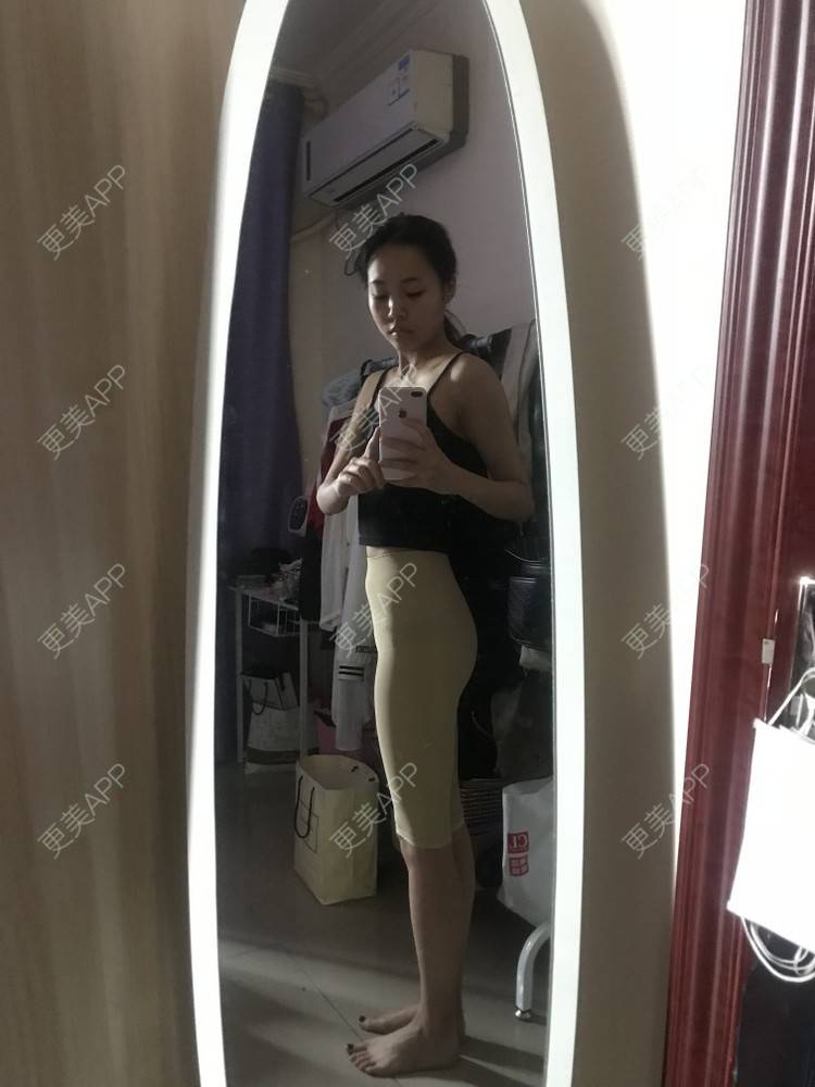 更美 - Rule宅男燃的吸脂经验 | 武汉 | 吸脂