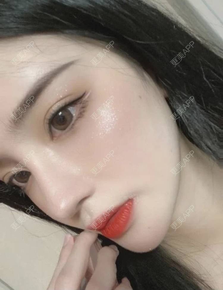 萝卜番茄酱的全切双眼皮日记