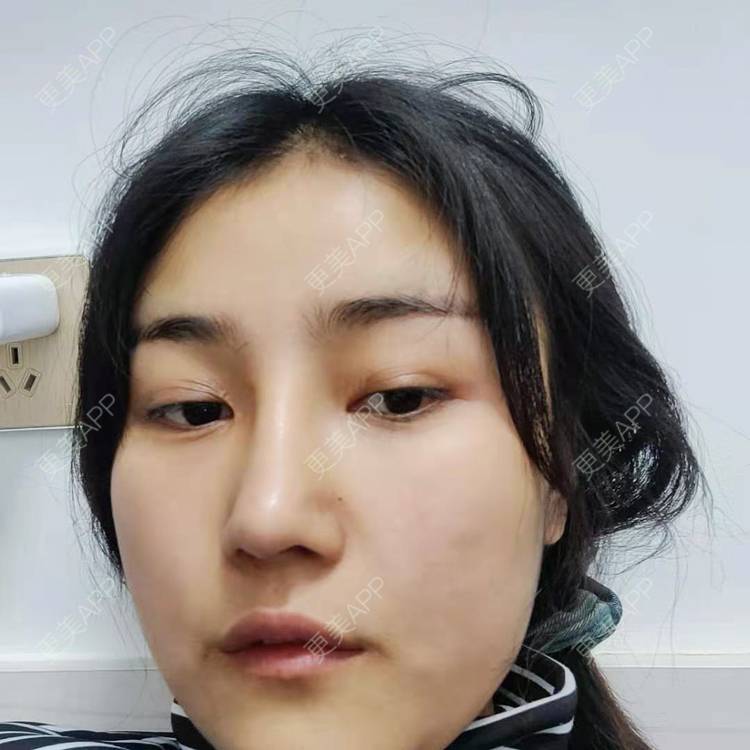 更美 - 更美用户6lAitmtq7D的自体脂肪填充泪沟经验 | 自体脂肪丰苹果肌 | 自体脂肪丰面颊 | 自体脂肪丰额头 | 自体脂肪垫下巴 | 自体脂肪全面部填充 | 自体脂肪填充泪沟 | 自体脂肪丰太阳穴 | 重庆 | 自体脂肪丰卧蚕 | 自体脂肪垫鼻基底 | 自体脂肪面部填充