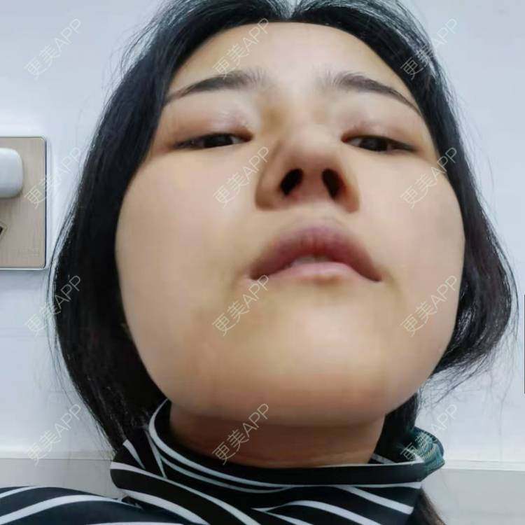 更美 - 更美用户6lAitmtq7D的自体脂肪填充泪沟经验 | 自体脂肪丰苹果肌 | 自体脂肪丰面颊 | 自体脂肪丰额头 | 自体脂肪垫下巴 | 自体脂肪全面部填充 | 自体脂肪填充泪沟 | 自体脂肪丰太阳穴 | 重庆 | 自体脂肪丰卧蚕 | 自体脂肪垫鼻基底 | 自体脂肪面部填充