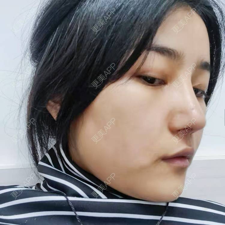 更美 - 更美用户6lAitmtq7D的自体脂肪填充泪沟经验 | 自体脂肪丰苹果肌 | 自体脂肪丰面颊 | 自体脂肪丰额头 | 自体脂肪垫下巴 | 自体脂肪全面部填充 | 自体脂肪填充泪沟 | 自体脂肪丰太阳穴 | 重庆 | 自体脂肪丰卧蚕 | 自体脂肪垫鼻基底 | 自体脂肪面部填充