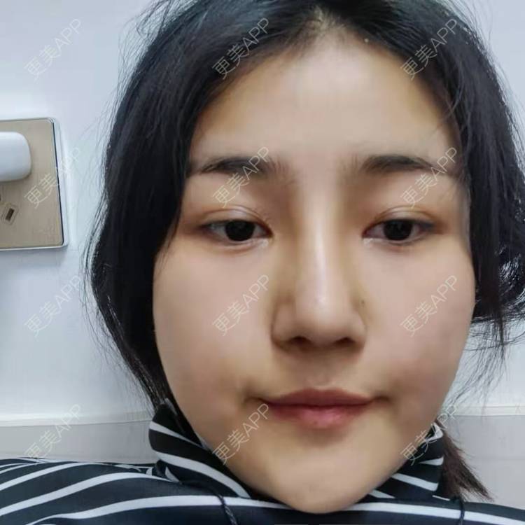 更美 - 更美用户6lAitmtq7D的自体脂肪填充泪沟经验 | 自体脂肪丰苹果肌 | 自体脂肪丰面颊 | 自体脂肪丰额头 | 自体脂肪垫下巴 | 自体脂肪全面部填充 | 自体脂肪填充泪沟 | 自体脂肪丰太阳穴 | 重庆 | 自体脂肪丰卧蚕 | 自体脂肪垫鼻基底 | 自体脂肪面部填充