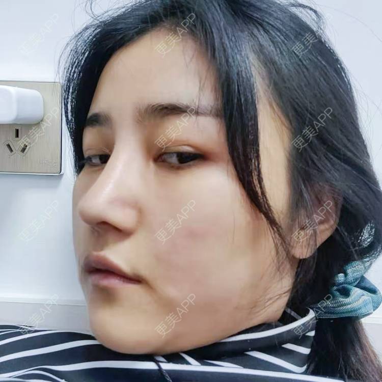 更美 - 更美用户6lAitmtq7D的自体脂肪填充泪沟经验 | 自体脂肪丰苹果肌 | 自体脂肪丰面颊 | 自体脂肪丰额头 | 自体脂肪垫下巴 | 自体脂肪全面部填充 | 自体脂肪填充泪沟 | 自体脂肪丰太阳穴 | 重庆 | 自体脂肪丰卧蚕 | 自体脂肪垫鼻基底 | 自体脂肪面部填充