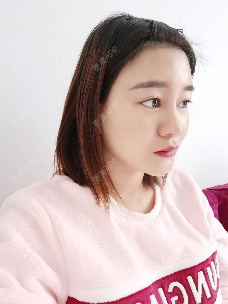 更美 - 更美用户pRSYJHvMHM的鬓角植发经验 | 植发际线 | 毛发移植 | 鬓角植发 | 美人尖植发 | 头顶加密种植 | 武汉