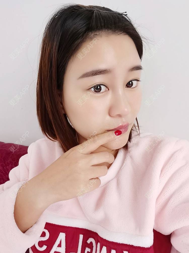 更美 - 更美用户pRSYJHvMHM的鬓角植发经验 | 植发际线 | 毛发移植 | 鬓角植发 | 美人尖植发 | 头顶加密种植 | 武汉