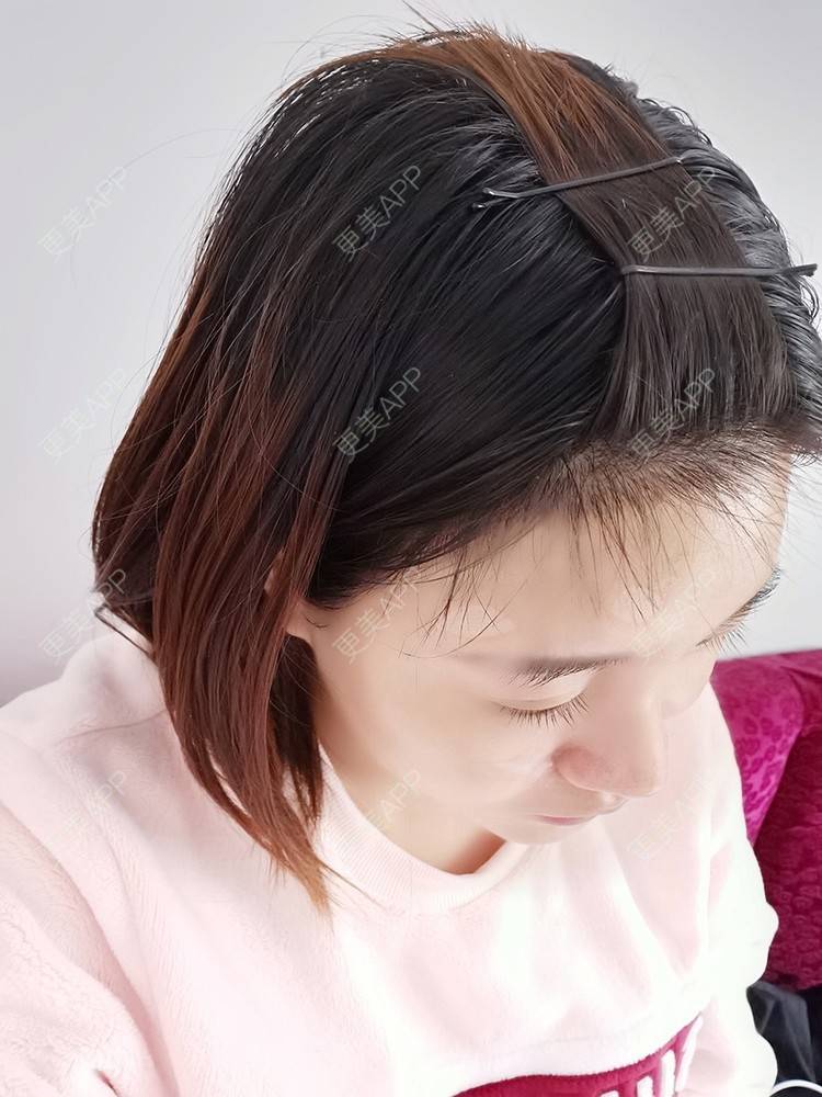 更美 - 更美用户pRSYJHvMHM的鬓角植发经验 | 植发际线 | 毛发移植 | 鬓角植发 | 美人尖植发 | 头顶加密种植 | 武汉