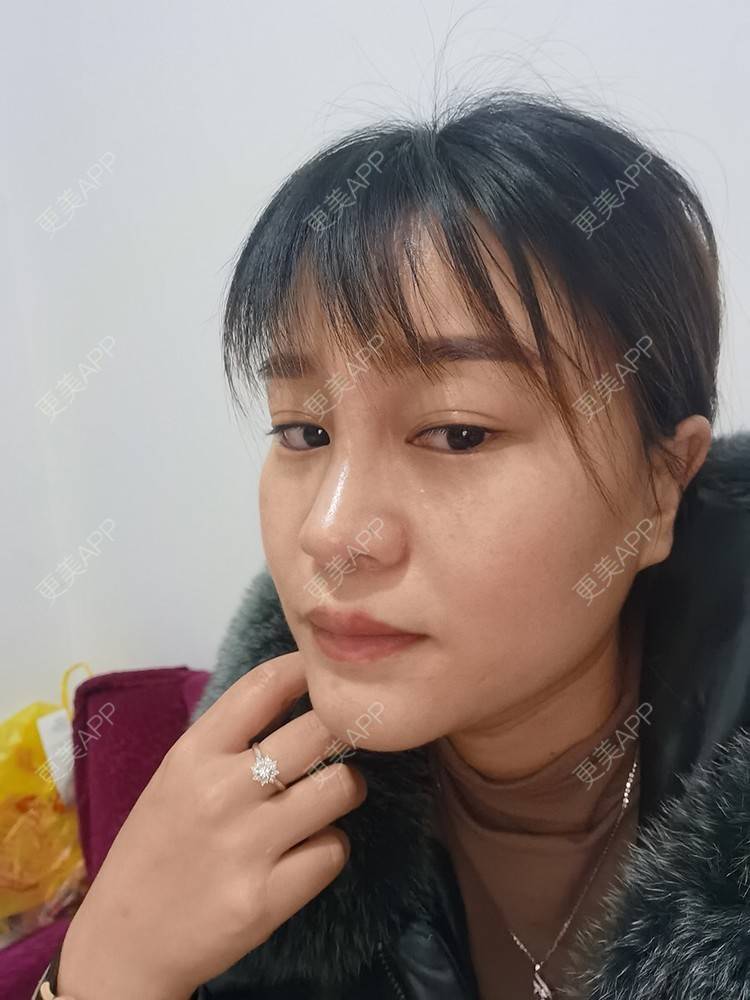 更美 - 更美用户pRSYJHvMHM的鬓角植发经验 | 植发际线 | 毛发移植 | 鬓角植发 | 美人尖植发 | 头顶加密种植 | 武汉
