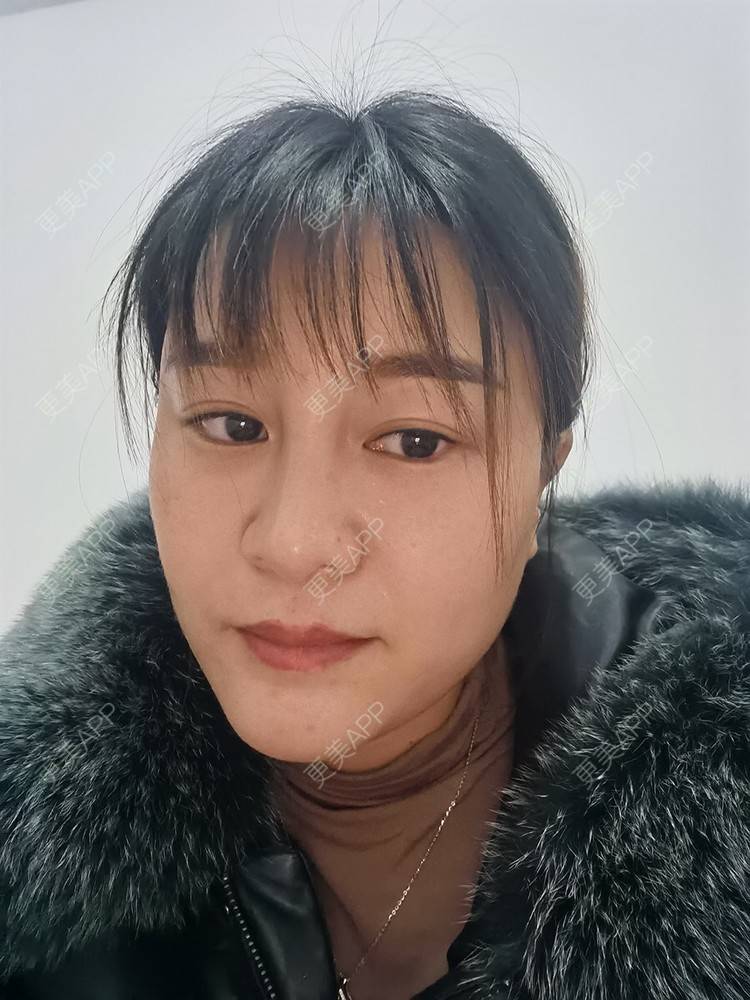 更美 - 更美用户pRSYJHvMHM的鬓角植发经验 | 植发际线 | 毛发移植 | 鬓角植发 | 美人尖植发 | 头顶加密种植 | 武汉