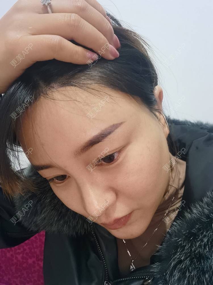更美 - 更美用户pRSYJHvMHM的鬓角植发经验 | 植发际线 | 毛发移植 | 鬓角植发 | 美人尖植发 | 头顶加密种植 | 武汉