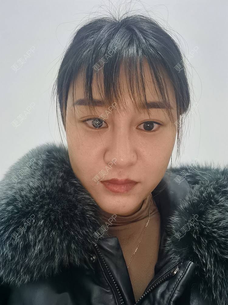 更美 - 更美用户pRSYJHvMHM的鬓角植发经验 | 植发际线 | 毛发移植 | 鬓角植发 | 美人尖植发 | 头顶加密种植 | 武汉