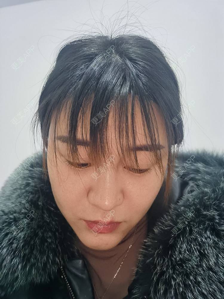 更美 - 更美用户pRSYJHvMHM的鬓角植发经验 | 植发际线 | 毛发移植 | 鬓角植发 | 美人尖植发 | 头顶加密种植 | 武汉